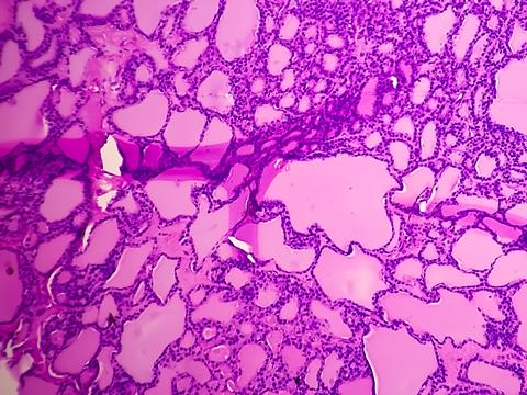 Synovial,Sarcoma,Histology,Image,Analyzed,By,Light,Microscope,At,Histopathology