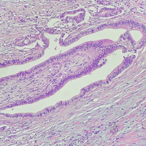 Camera,Photo,Of,Cholangiocarcinoma,With,Perineural,Invasion,,Magnification,200x,,Photograph