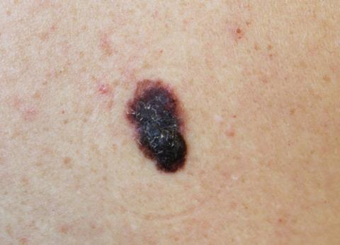 Melanoma,-,A,Malignant,Tumor,Of,Human,Skin