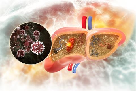 Liver,Cancer,Or,Liver,Tumor,,Hepatocellular,Carcinoma,(hcc),,Causes,,Symptoms,