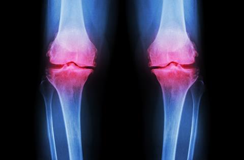 Osteoarthritis,Knee,(,Oa,Knee,).,Film,X-ray,Both,Knee