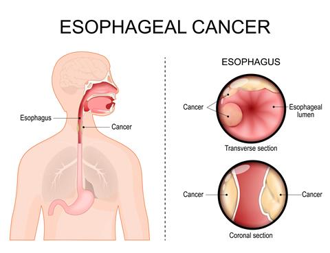 Esophageal,Cancer.,Transverse,Section,And,Coronal,Section,Of,Esophagus.,Adenocarcinoma.