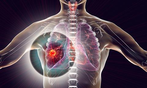 Lung-cancer-image