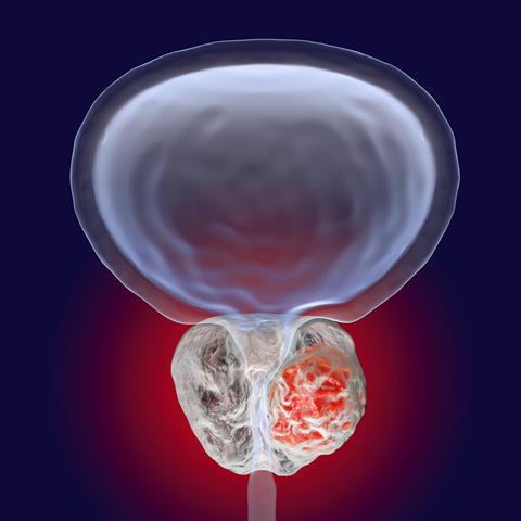 Prostate,Cancer,,3d,Illustration,Showing,Presence,Of,Tumor,Inside,Prostate