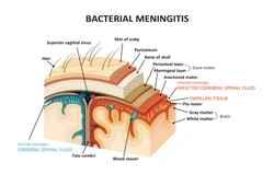 bacterial-meningitis-infection-meninges-brain-250nw-1045722319