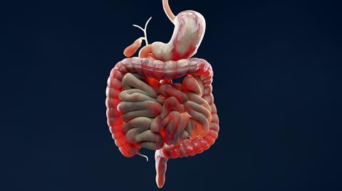 Man,Suffering,From,Crohns,Disease,,Male,Anatomy,,Inflamed,Large,Intestine,